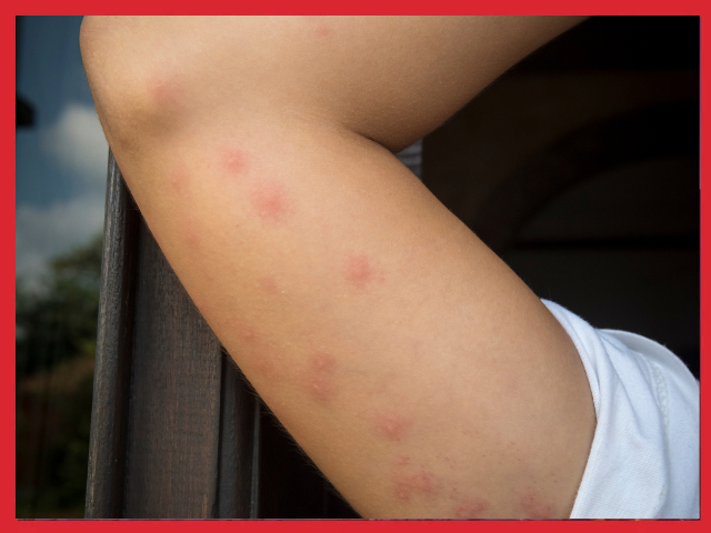 ślady ukąszeń owadów pluskwy
